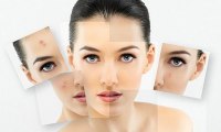 Холистический подход к лечению акне: 6 советов article-image
